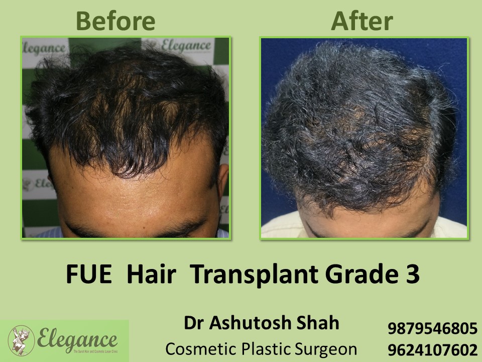 FUE Hair Transplant, Grade 3, Hair Baldness in  Surat