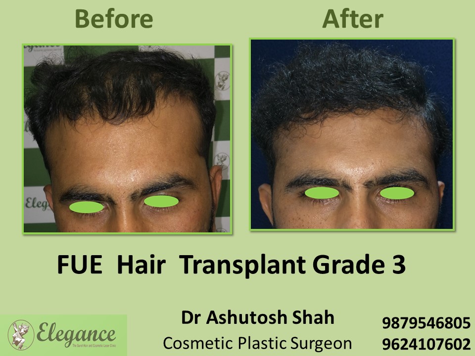 FUE Hair Transplant, Grade 3, Hair Baldness in Vesu, Surat