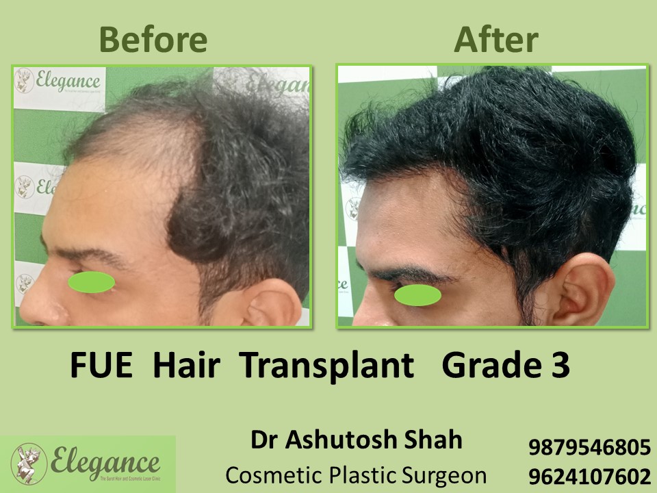 Hair Regrowth, Grade 3 Hair Transplant in Adajan, Surat
