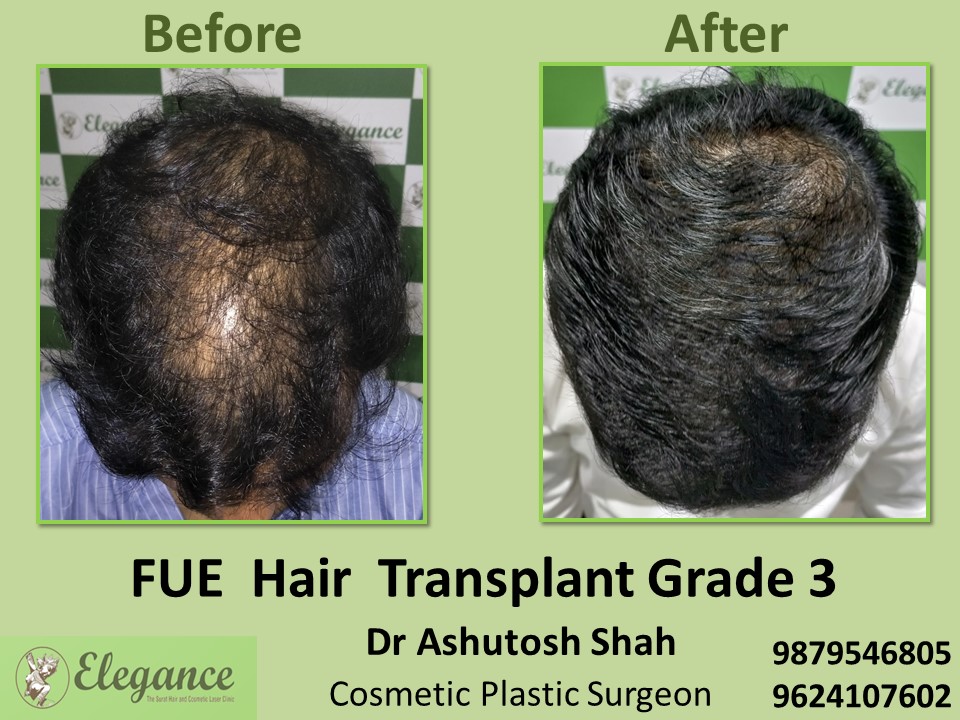 Hair Regrowth, Grade 3 Hair Transplant in Surat