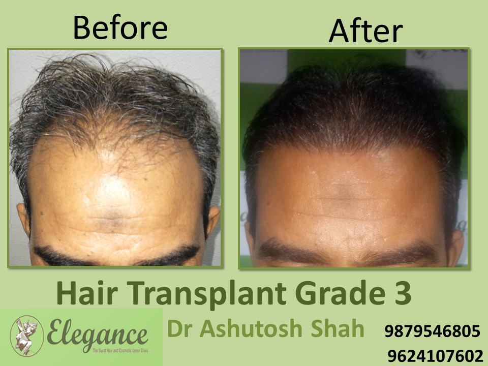 Grade 3 Hair Transplant In Mumbai, Maharashtra, India