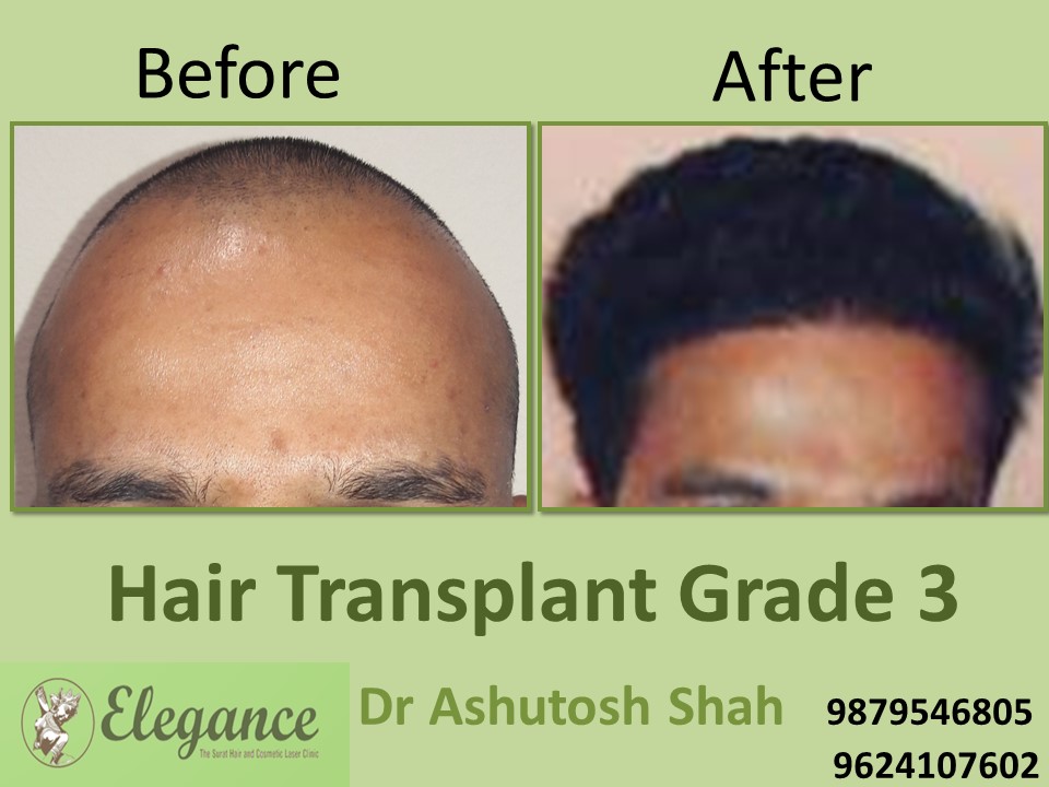 Grade 3 Hair Transplant In Pune, Maharashtra, India