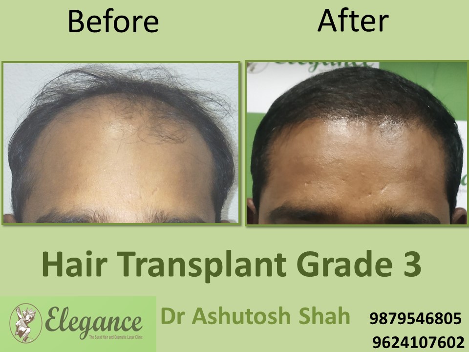 Grade 3 Hair Transplant In Delhi, India