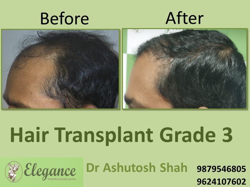 Grade 3 Hair Transplant In Bangalore, Karnataka, India