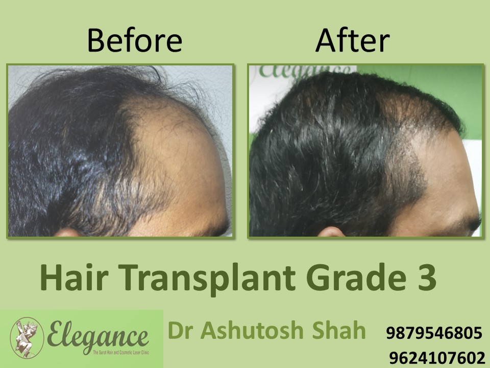 Grade 3 Hair Transplant In Hyderabad, Telangana, India