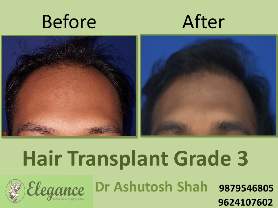 Grade 3 Hair Transplant In Ahmedabad, Gujarat, India