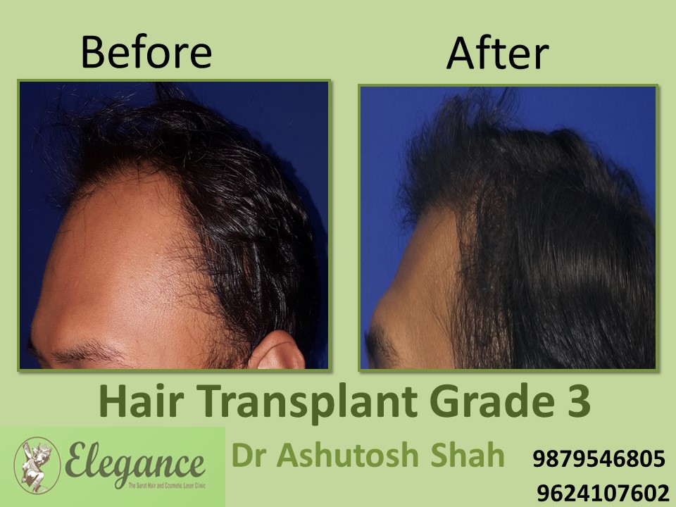 Grade 3 Hair Transplant In Surat, Gujarat, India
