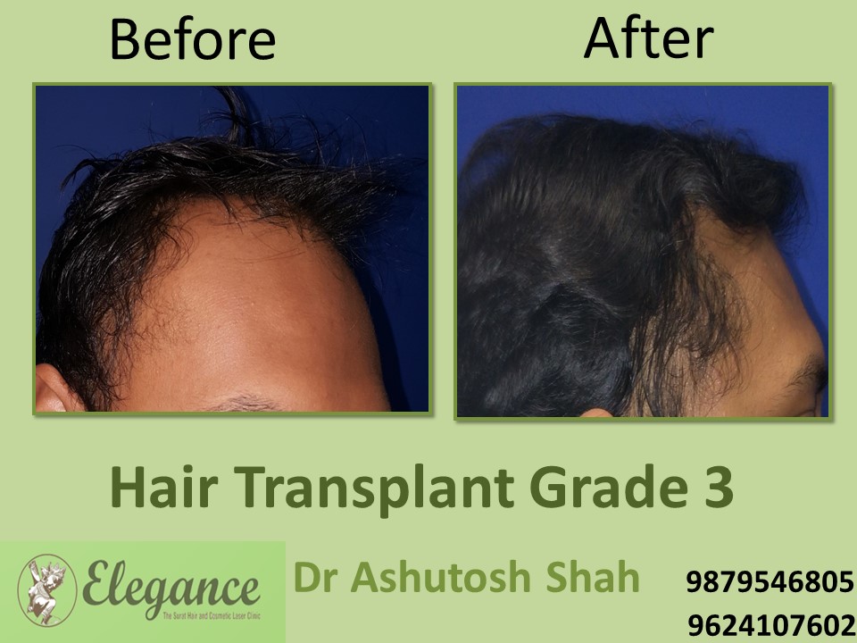 Grade 3 Hair Transplant Doctor In Surat, Gujarat, India