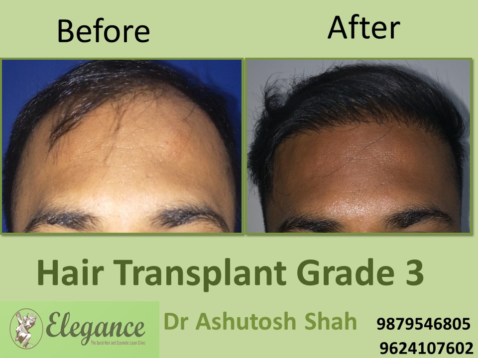 Grade 3 Hair Transplant Cost In Surat, Gujarat, India