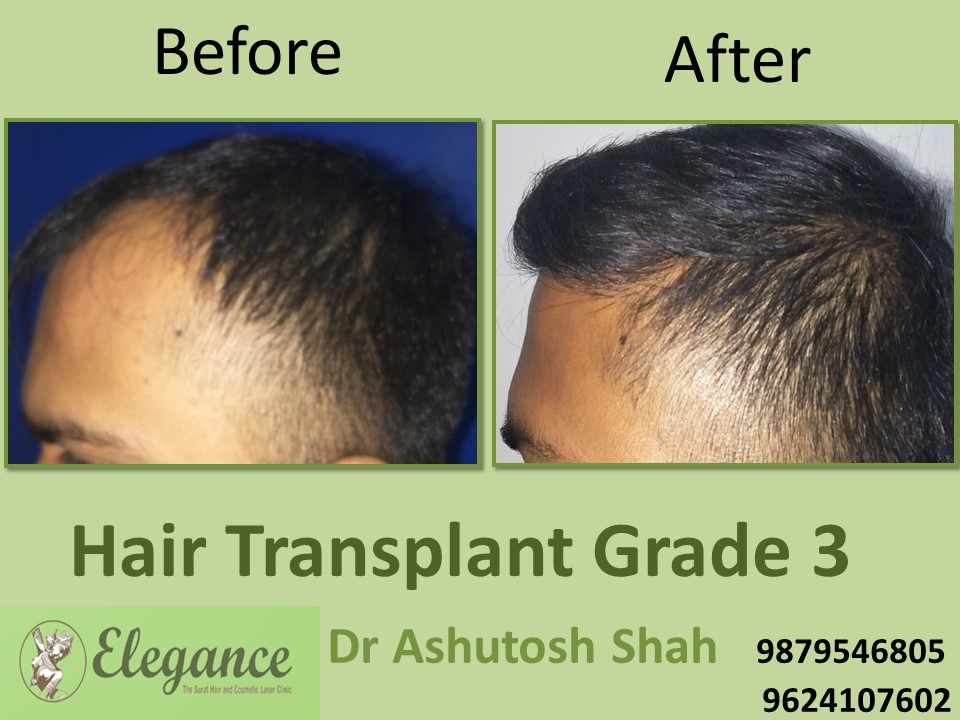 Grade 3 Hair Transplant Price In Surat, Gujarat, India