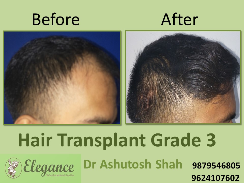 Grade 3 Hair Transplant Surgery In Surat, Gujarat, India