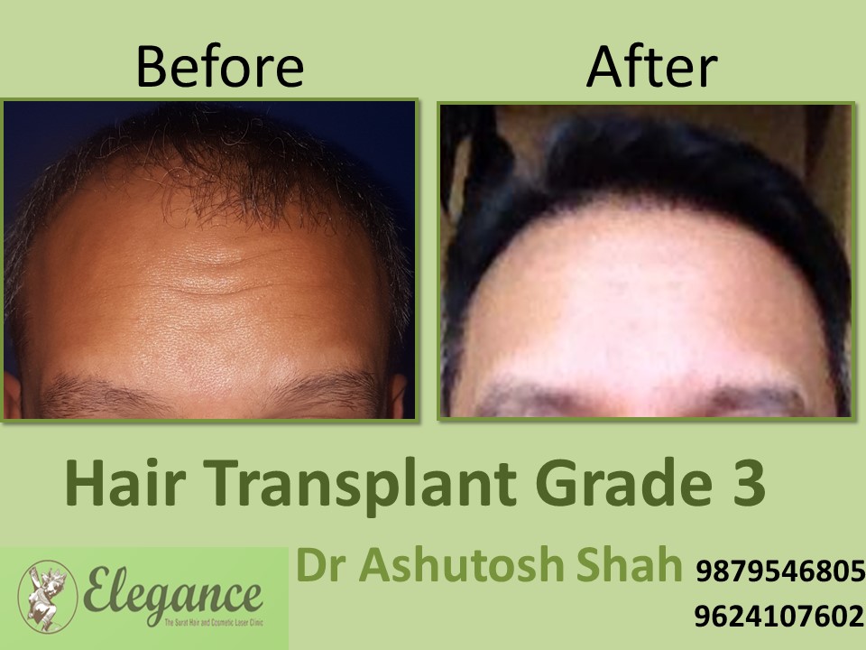 Grade 3 Hair Transplant Treatmnet In Surat, Gujarat, India