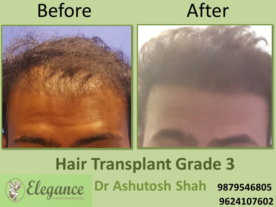 Grade 3 Hair Transplant In Kolkata, West Bengal, India