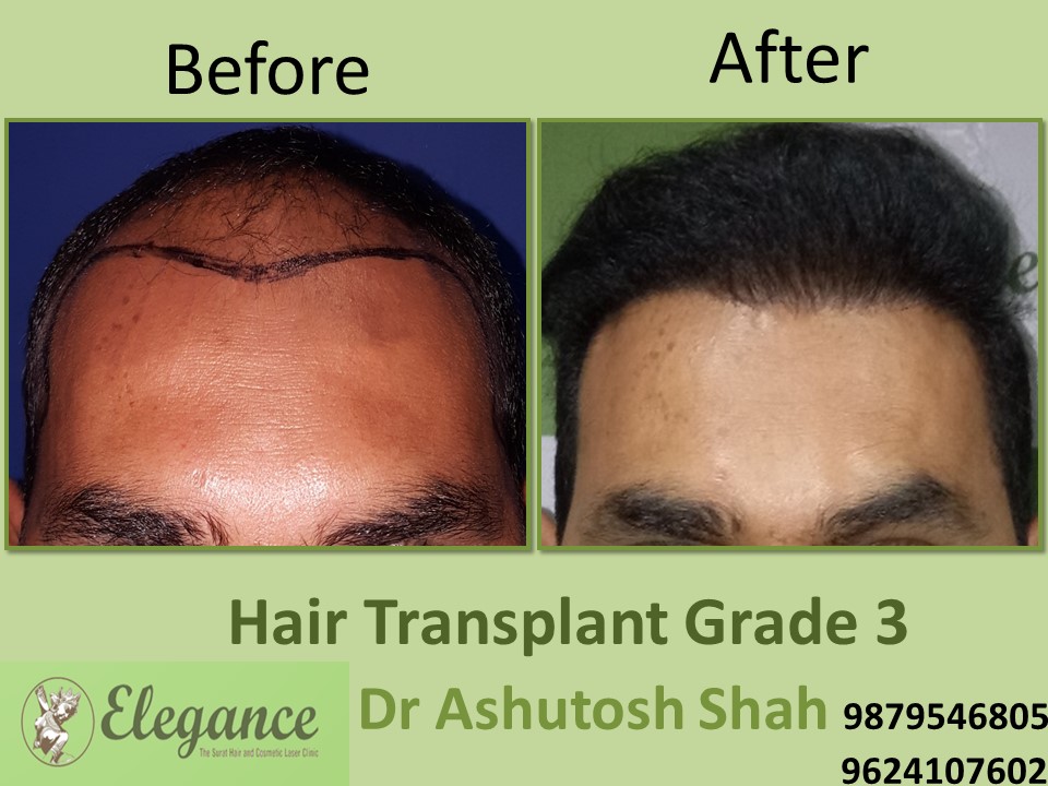 Grade 3 Hair Transplant In Jaipur, Rajasthan, India