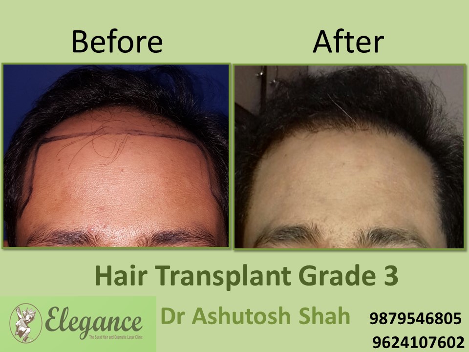 Grade 3 Hair Transplant In Lucknow, Uttar Pradesh, India