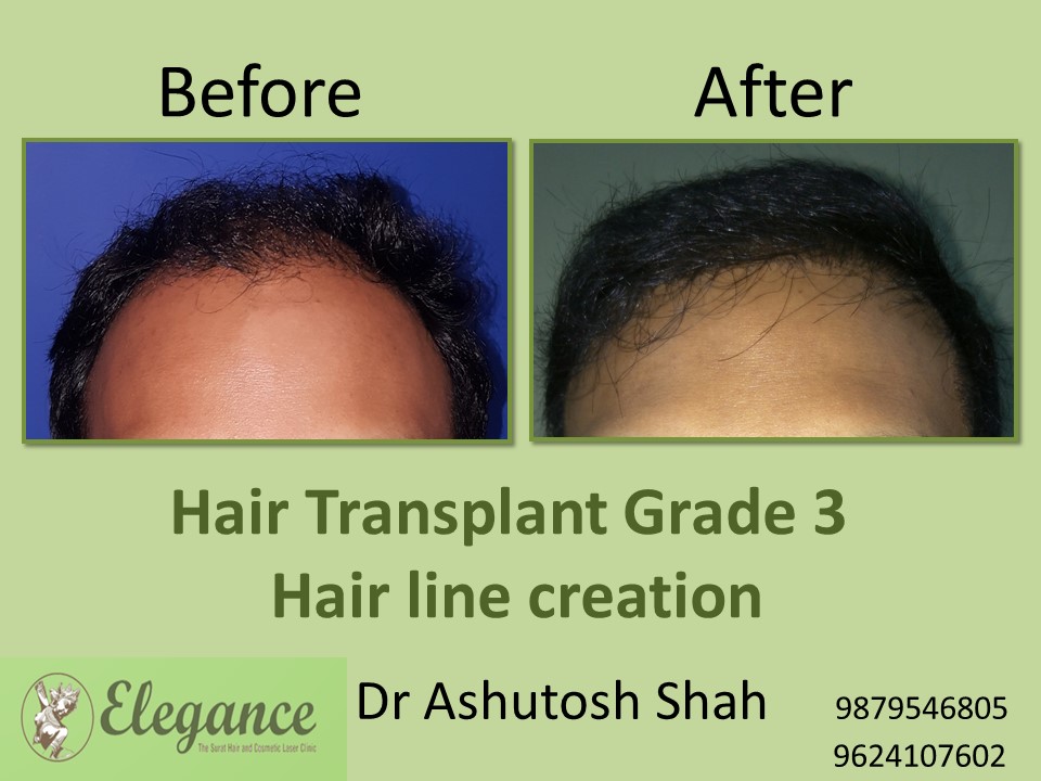 Grade 3 Hair Transplant In Kanpur, Uttar Pradesh, India