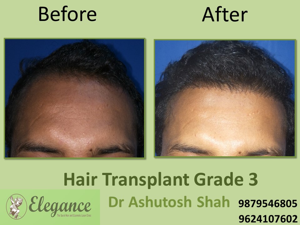 Grade 3 Hair Transplant In Nagpur, Maharashtra, India