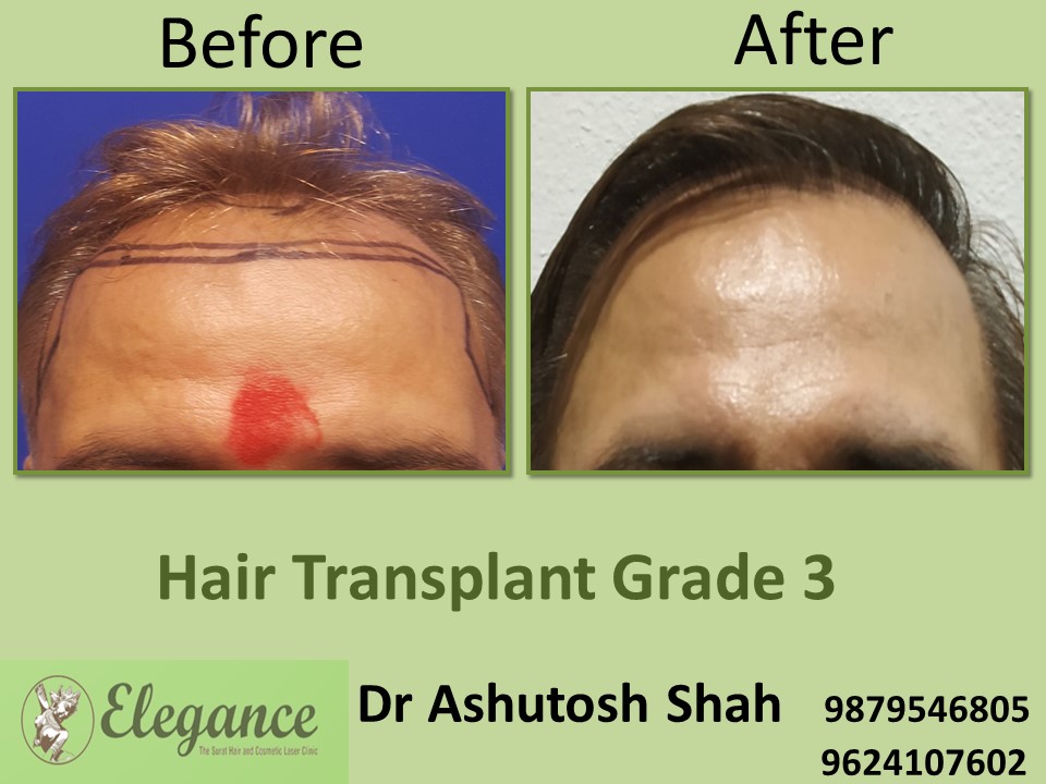 Grade 3 Hair Transplant In Indore, Madhya Pradesh, India