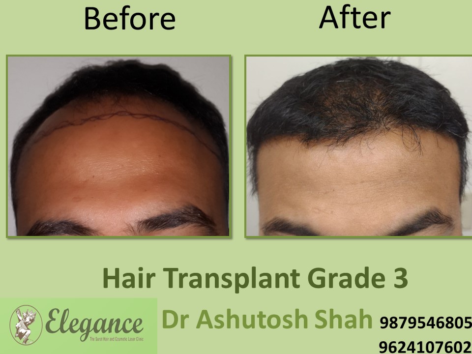Grade 3 Hair Transplant In Thane, Maharashtra, India
