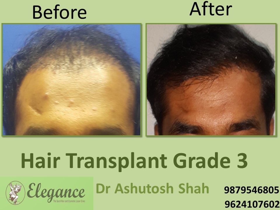 Grade 3 Hair Transplant In Bhopal, Madhya Pradesh, India