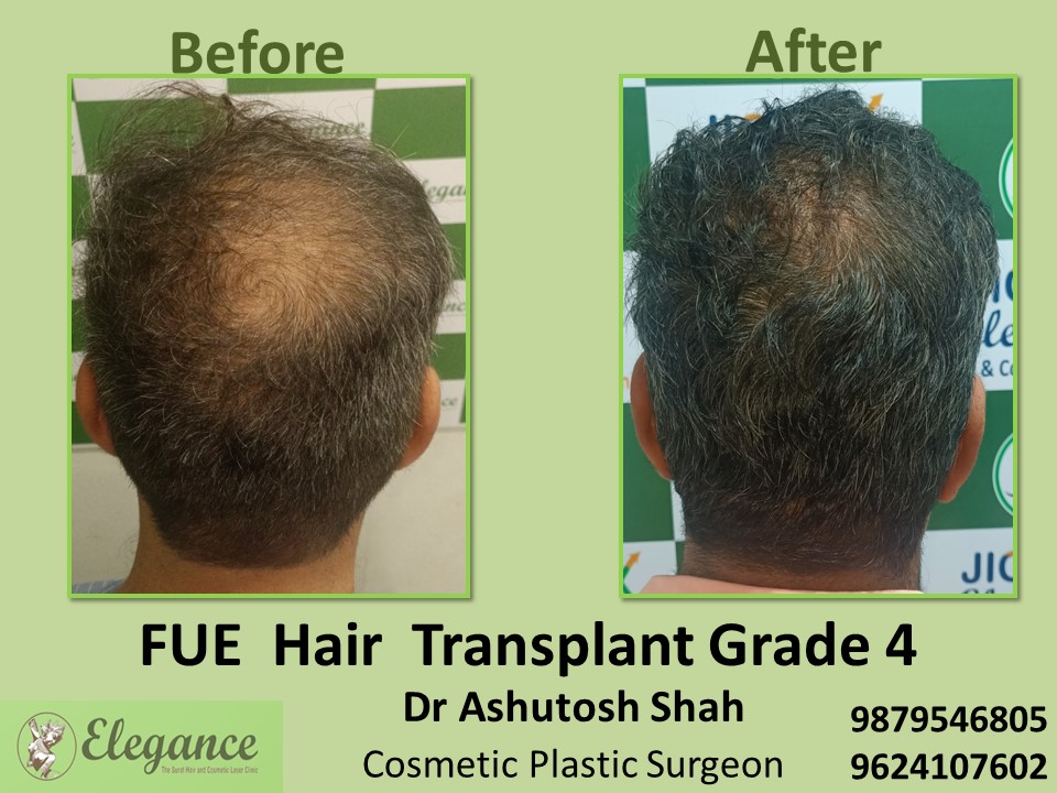 FUE Hair Transplant, Hair Regrowth in Piplod, Surat