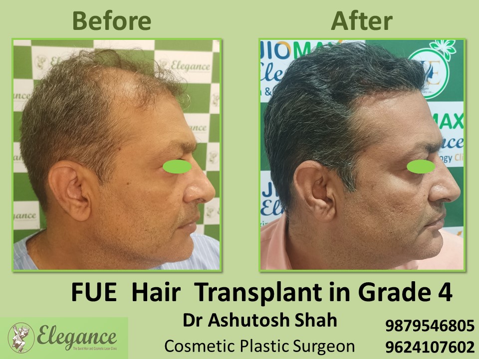 Grade 4, FUE Hair Transplant in  Pal, Adajan, Surat