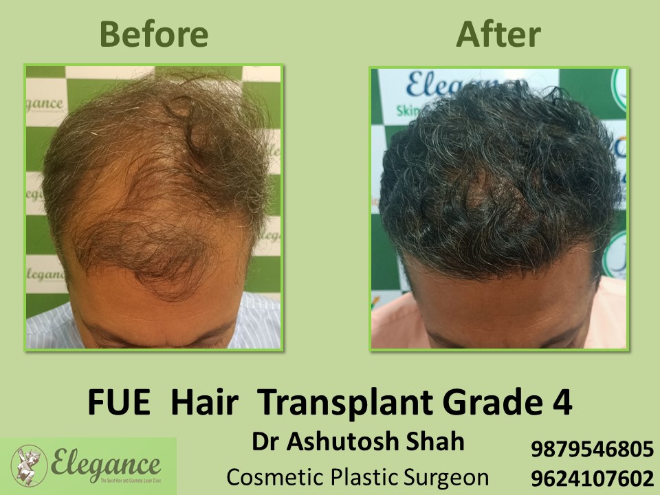 Grade 4, FUE Hair Transplant in Piplod, Surat