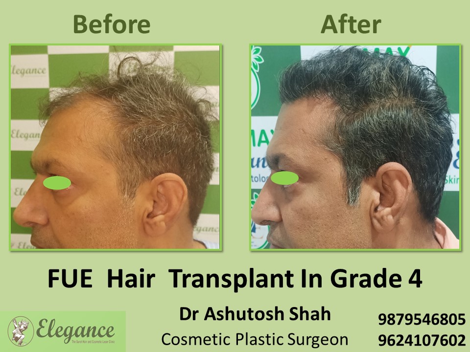 Hair Growth, Grade 4, FUE Hair Transplant in Piplod, Surat