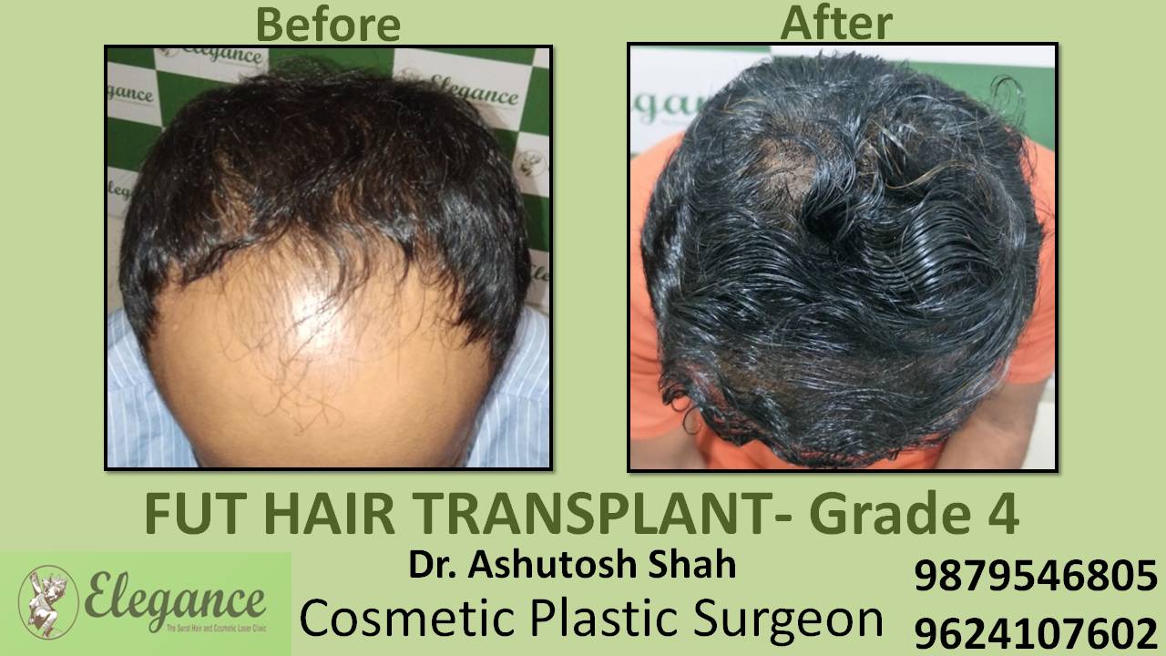 Hair Transplant Sugery in Ankleshwar, Gujarat, india