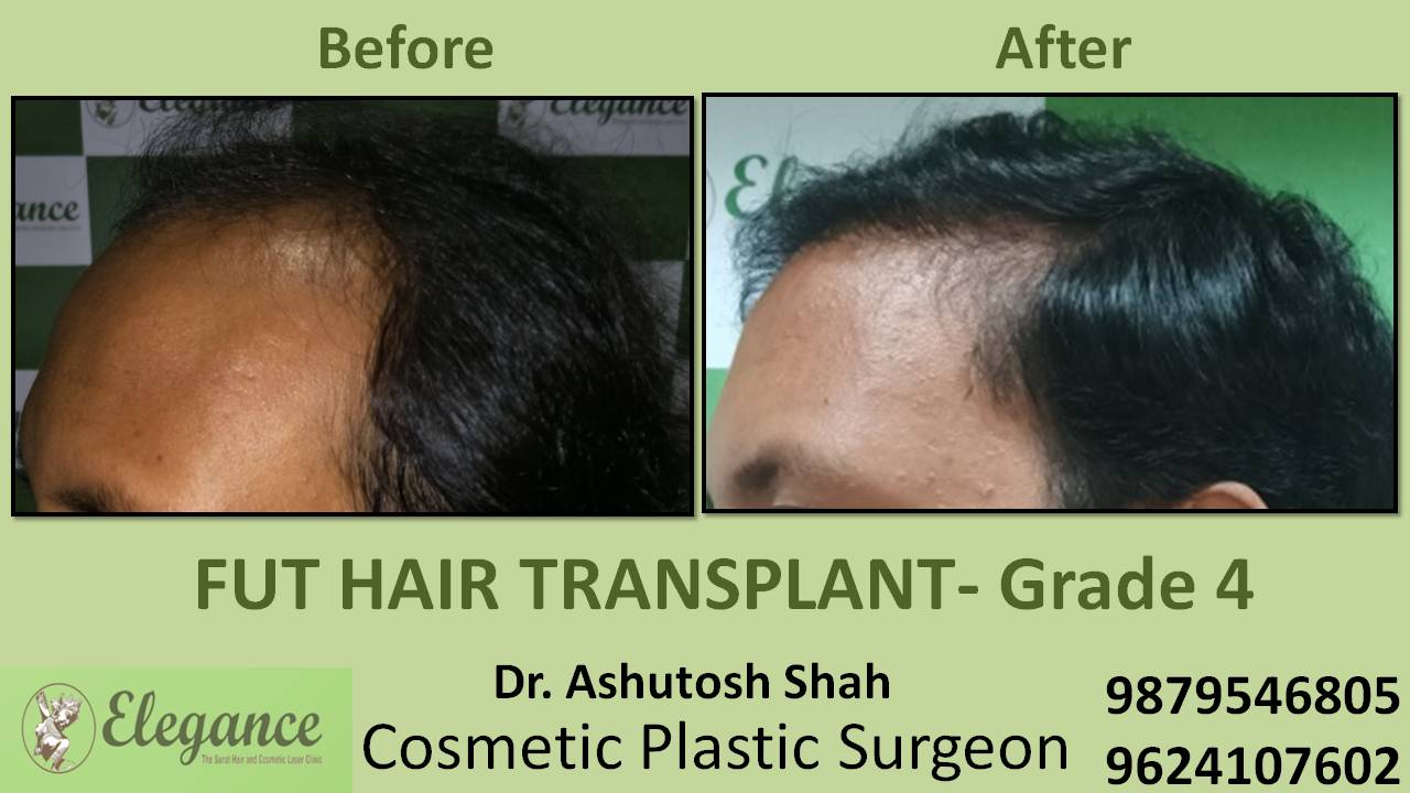 Hair Transplant In Ahmadabad, Gujarat, India
