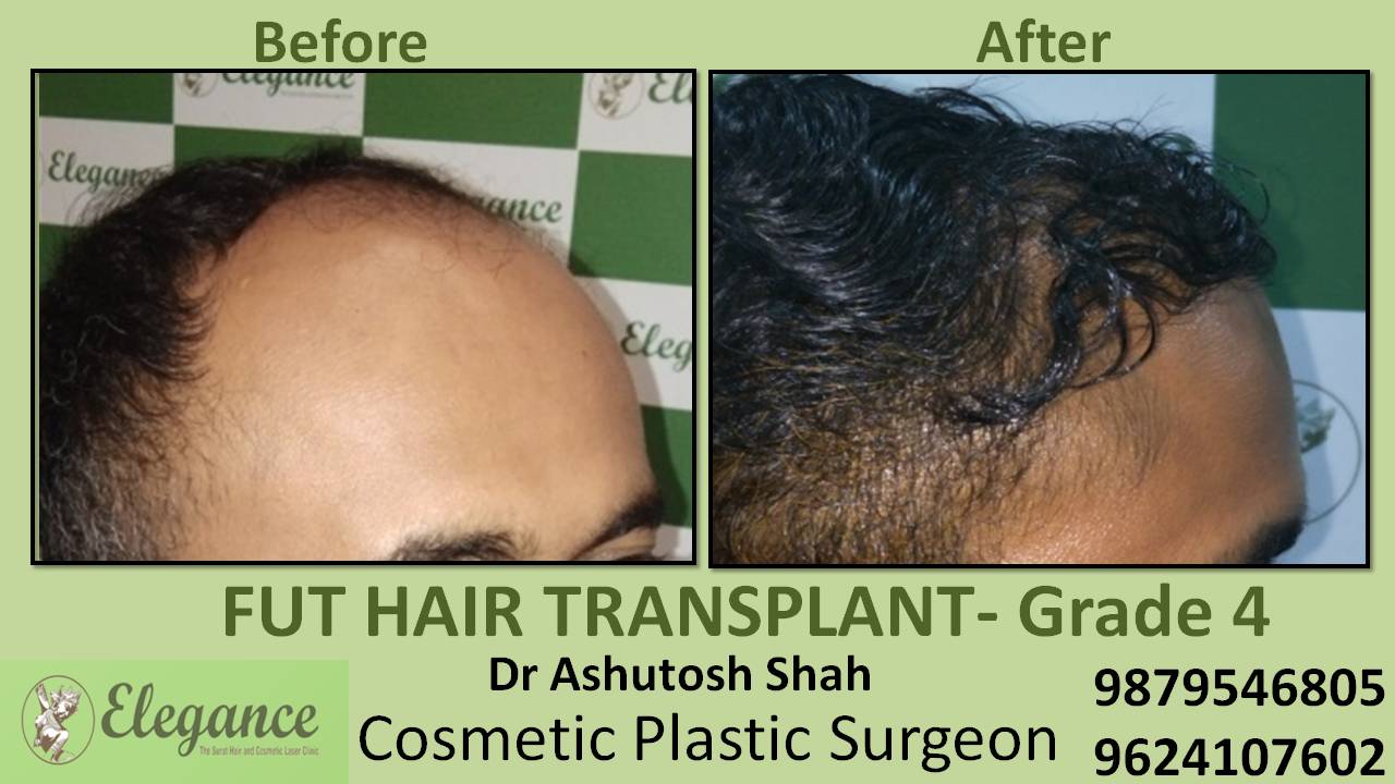 Hair Transplant In Nasik, Maharashtra, India