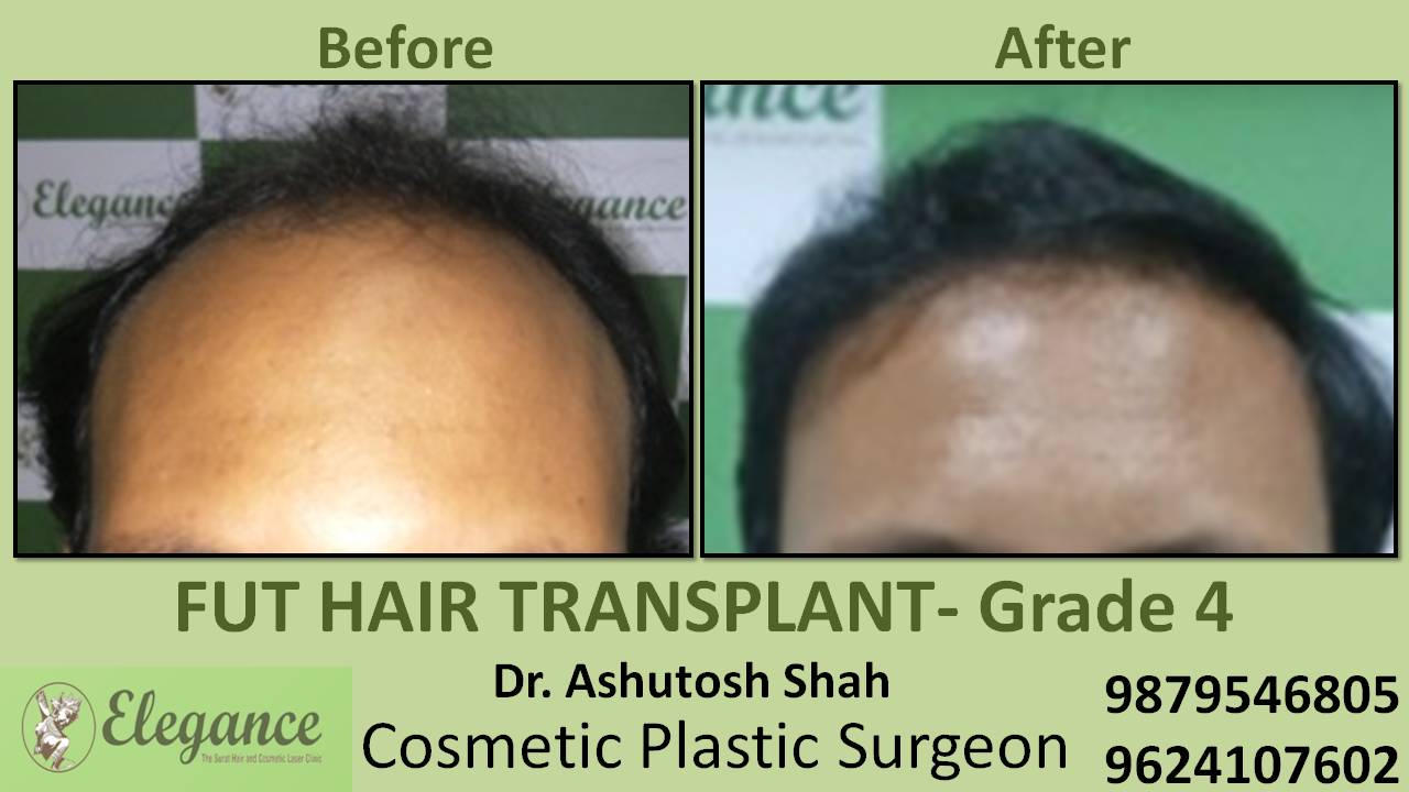 Hair Transplant In Pune, Maharashtra, India