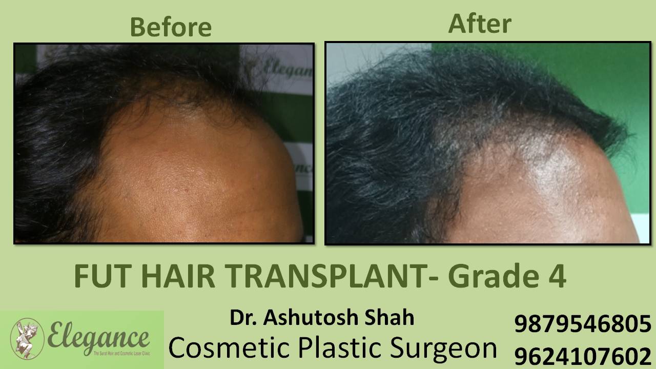 Hair Transplant Price In Bharuch, Gujarat, India