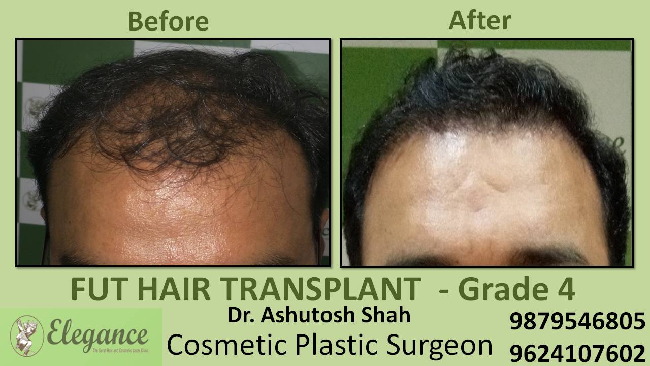 Hair Transplant In Diu, Gujarat, India