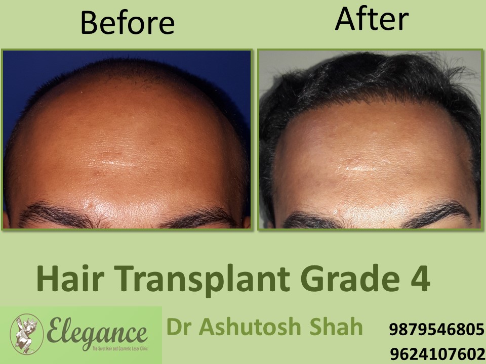 Grade 4 Hair Transplant In Surat, Gujarat, India