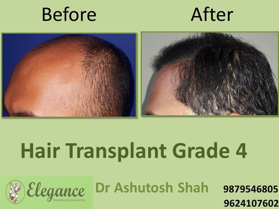 Grade 4 Hair Transplant Doctor In Surat, Gujarat, India