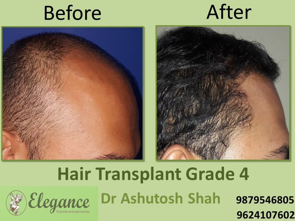 Grade 4 Hair Transplant Cost In Surat, Gujarat, India