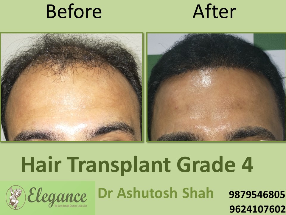 Grade 4 Hair Transplant Price In Surat, Gujarat, India