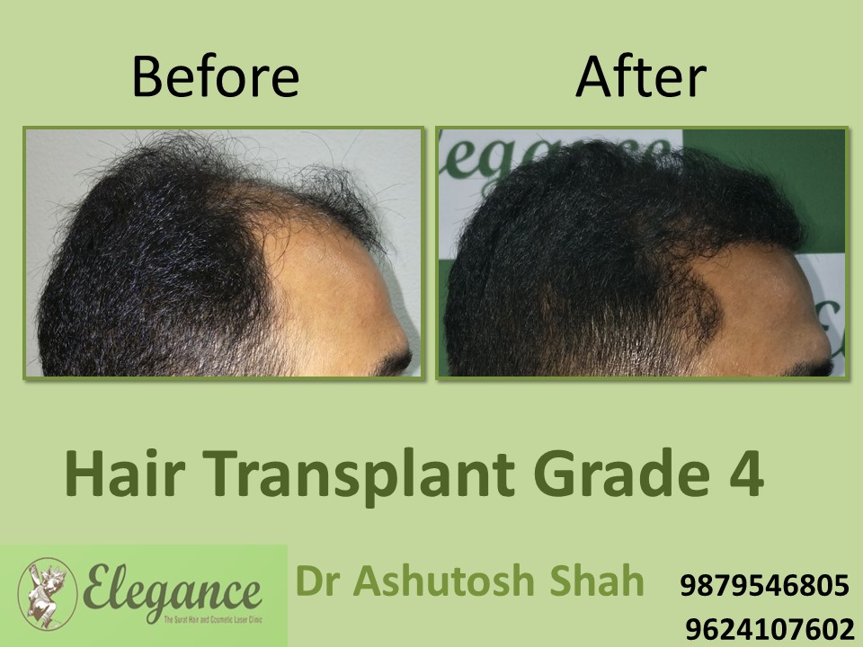 Grade 4 Hair Transplant Surgery In Surat, Gujarat, India