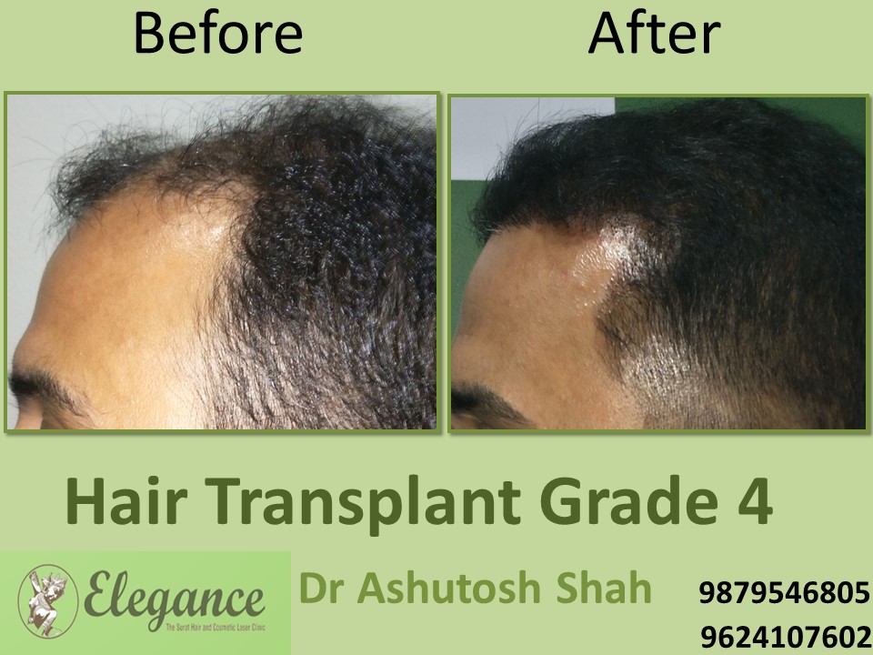 Grade 4 Hair Transplant In Vapi, Gujarat, India