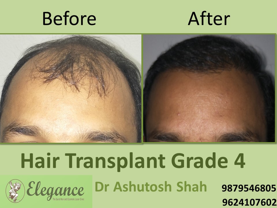 Grade 4 Hair Transplant In Valsad, Gujarat, India