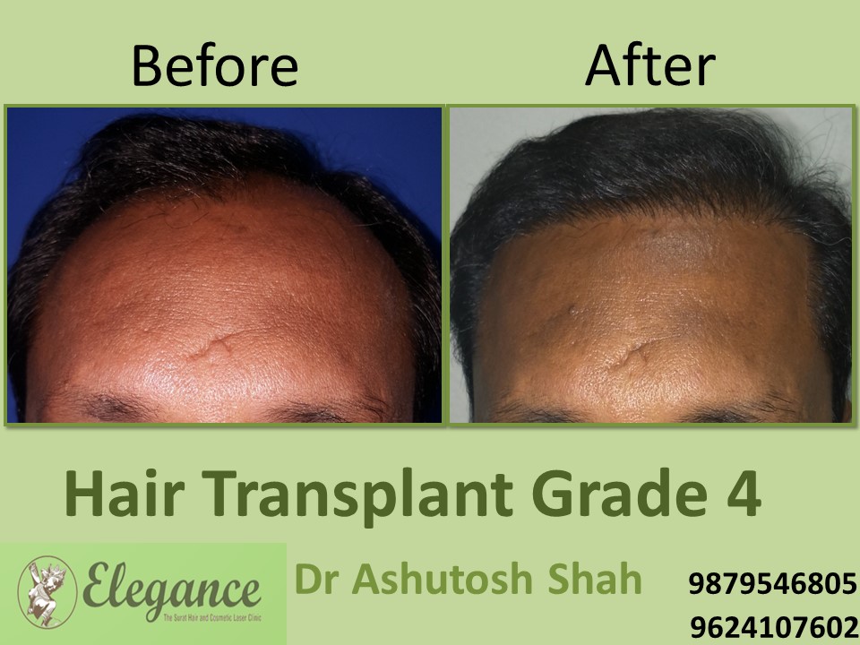 Grade 4 Hair Transplant In Rajkot, Gujarat, India