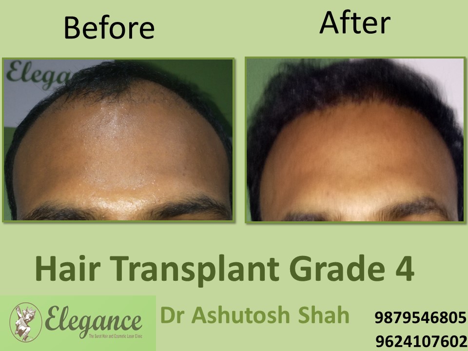 Grade 4 Hair Transplant In Ahmedabad, Gujarat, India