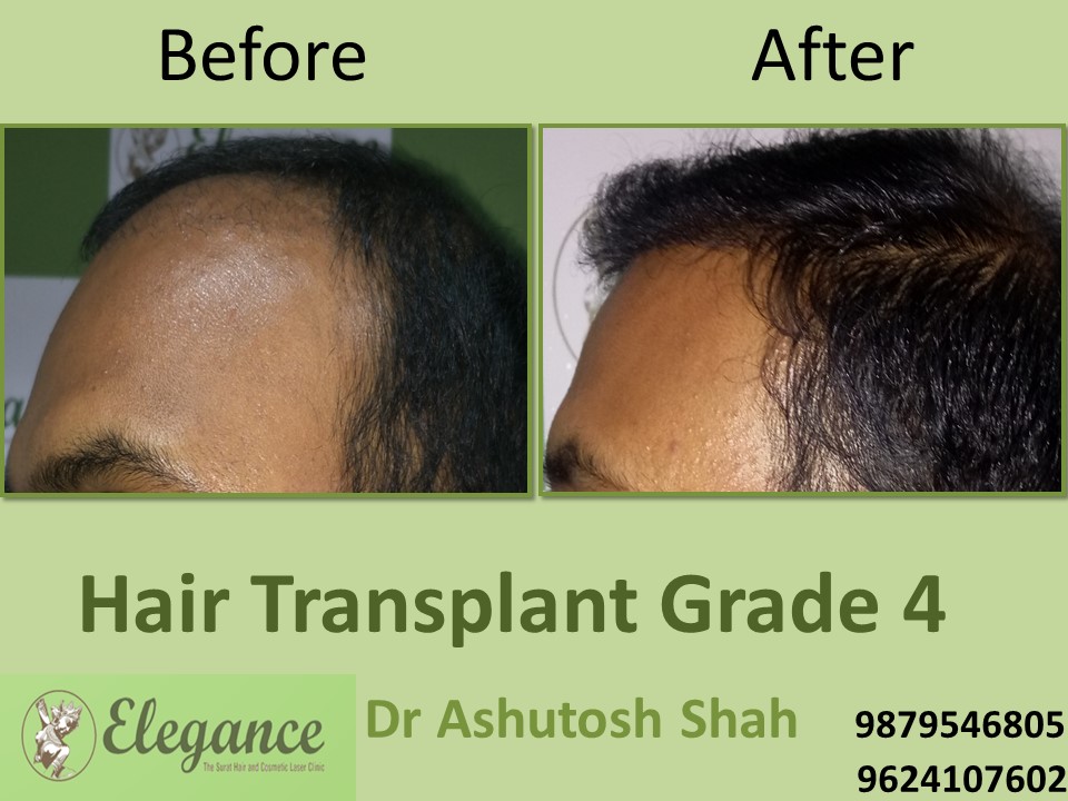 Grade 4 Hair Transplant In Amreli, Gujarat, India