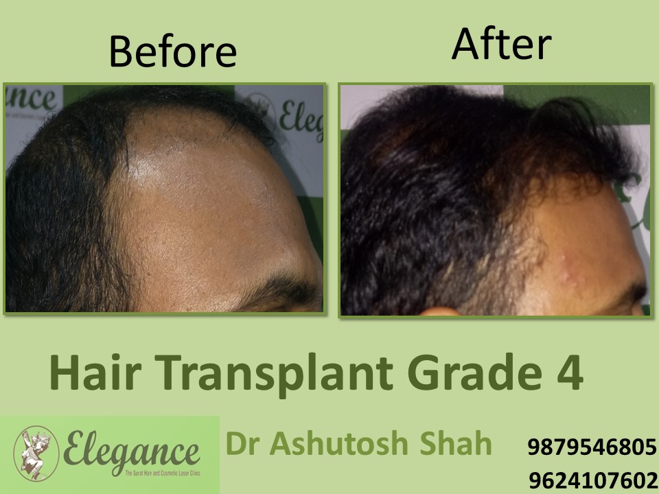 Grade 4 Hair Transplant In Botad, Gujarat, India