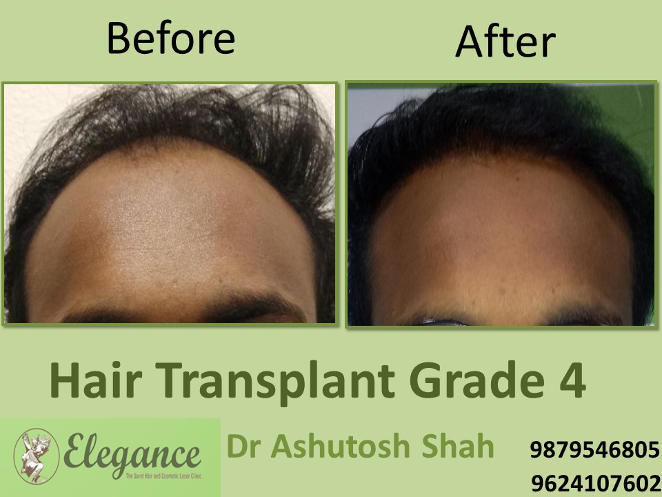 Grade 4 Hair Transplant In Vadodara, Gujarat, India