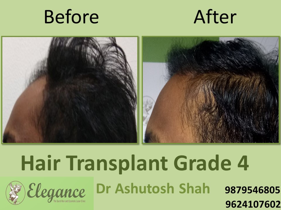 Grade 4 Hair Transplant In Gandhinagar, Gujarat, India