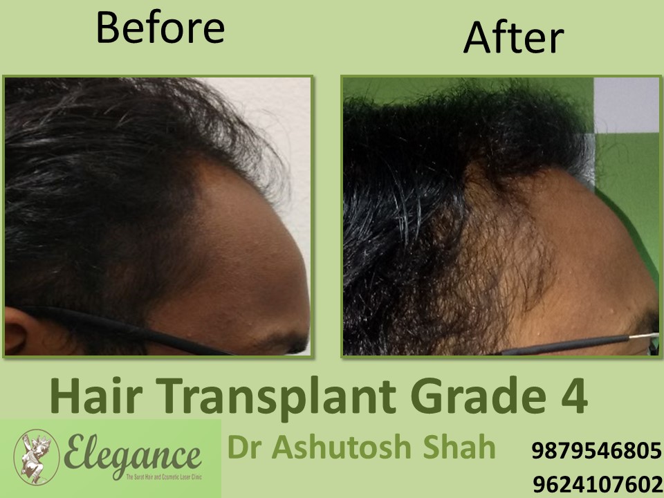 Grade 4 Hair Transplant In Jamnagar, Gujarat, India
