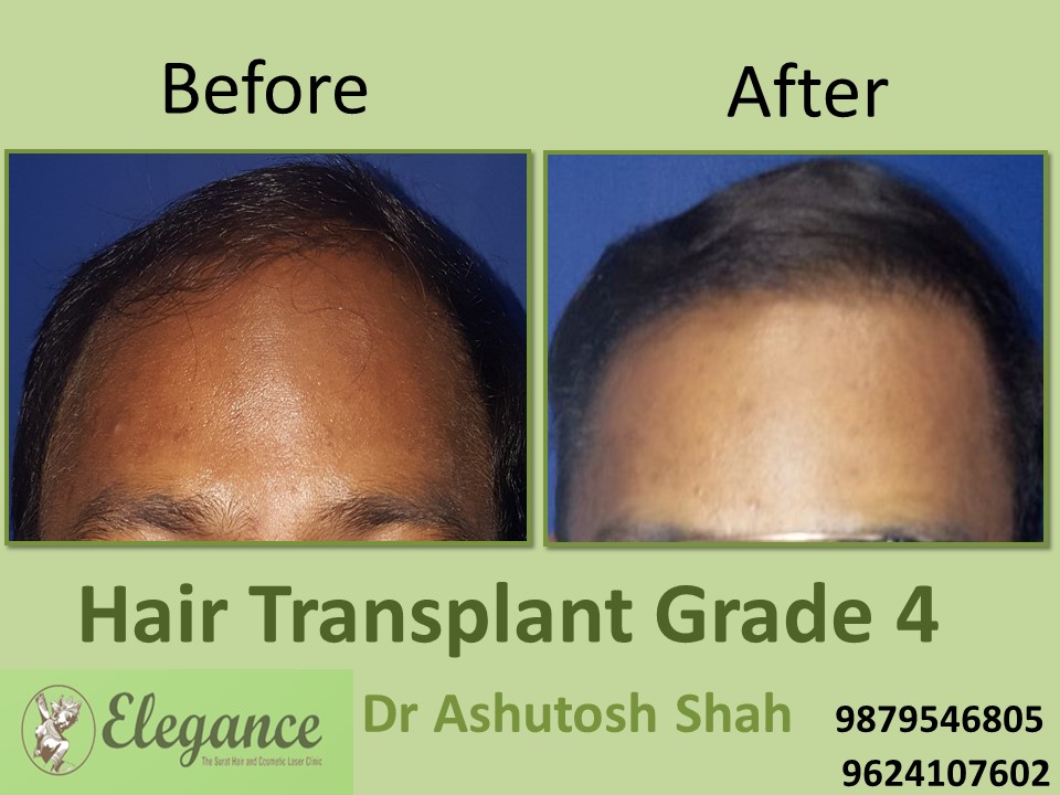 Grade 4 Hair Transplant In Junagadh, Gujarat, India