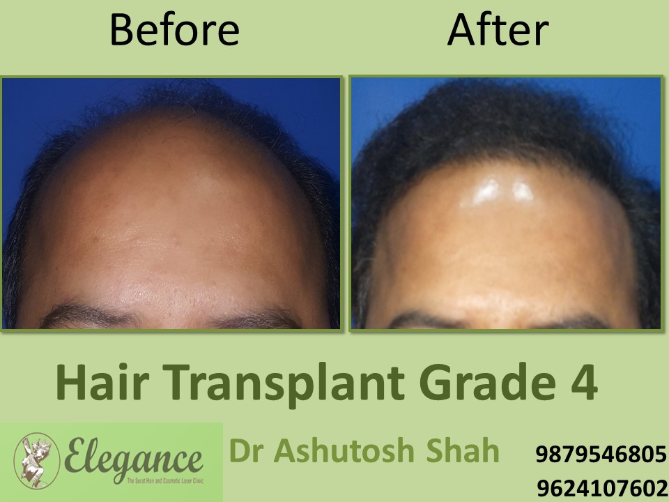 Grade 4 Hair Transplant In Anand, Gujarat, India